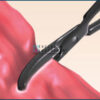 ENERTECH Vessel Sealing System - Image 3