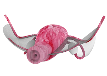 Uterine GEM silicone model for laparoscopic gynecological surgery training and suturing practice